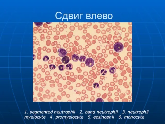 Сдвиг влево 1. segmented neutrophil 2. band neutrophil 3. neutrophil myelocyte