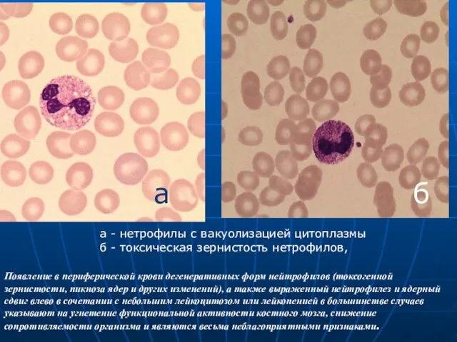 а - нетрофилы с вакуолизацией цитоплазмы б - токсическая зернистость нетрофилов,