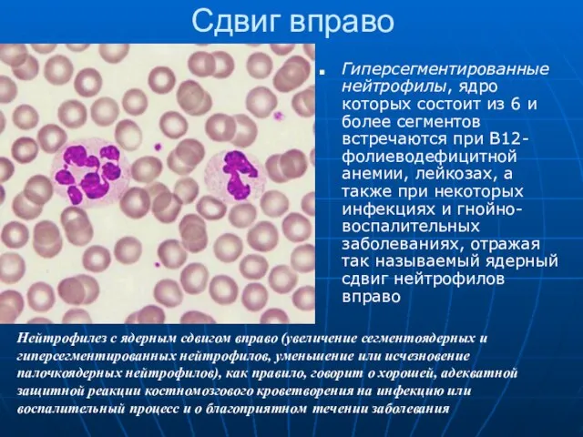 Сдвиг вправо Гиперсегментированные нейтрофилы, ядро которых состоит из 6 и более