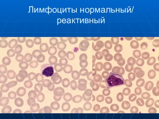 Лимфоциты нормальный/ реактивный