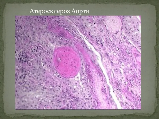 Атеросклероз Аорти