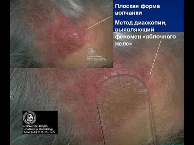 Плоская форма волчанки Метод диаскопии, выявляющий феномен «яблочного желе»