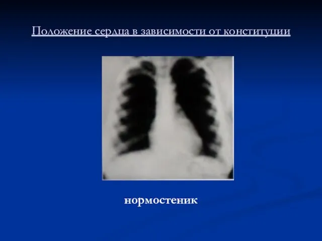 Положение сердца в зависимости от конституции нормостеник