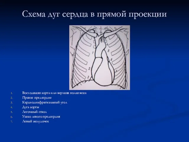 Схема дуг сердца в прямой проекции Восходящяя аорта или верхняя полая