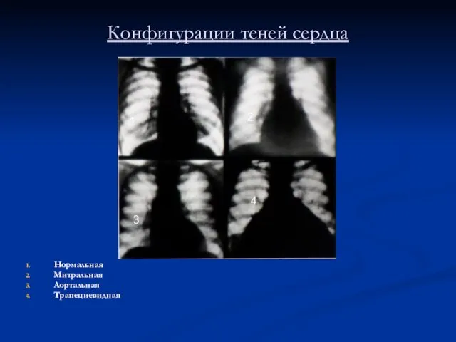 Конфигурации теней сердца Нормальная Митральная Аортальная Трапециевидная 1 2 3 4