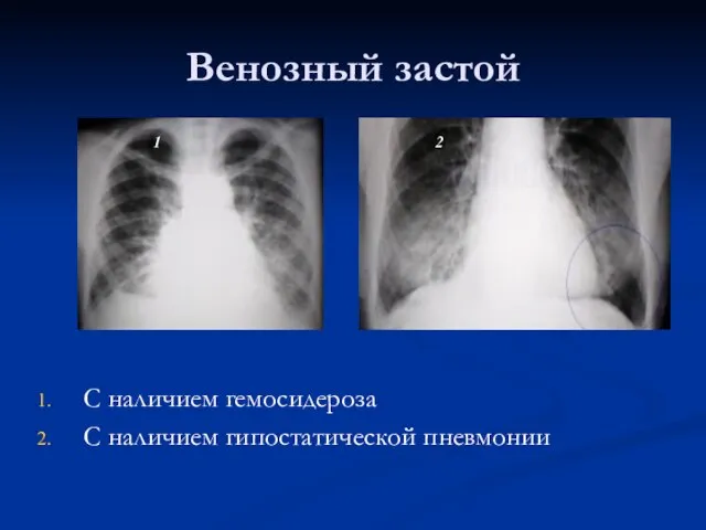 Венозный застой С наличием гемосидероза С наличием гипостатической пневмонии 1 2