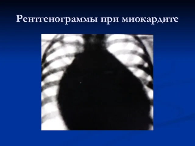 Рентгенограммы при миокардите