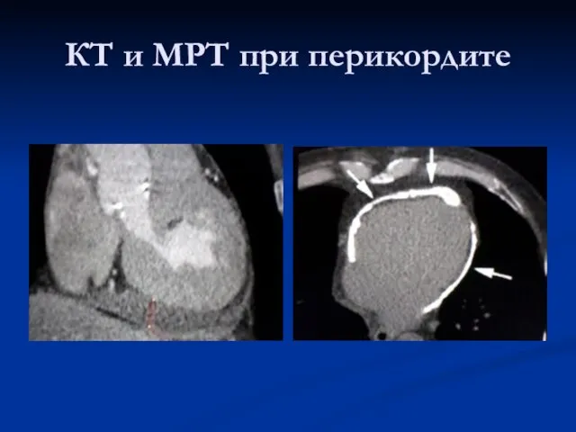 КТ и МРТ при перикордите