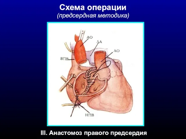 Схема операции (предсердная методика) III. Анастомоз правого предсердия