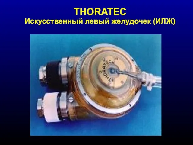 THORATEC Искусственный левый желудочек (ИЛЖ)