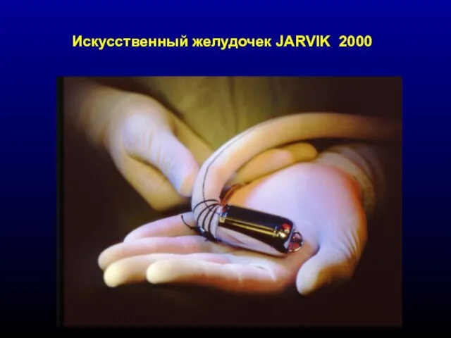 Искусственный желудочек JARVIK 2000