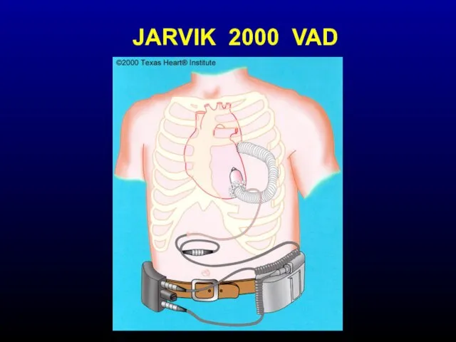 JARVIK 2000 VAD