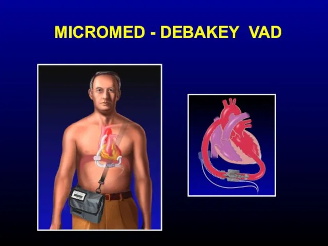 MICROMED - DEBAKEY VAD