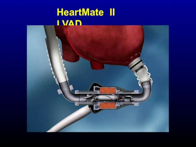 HeartMate II LVAD