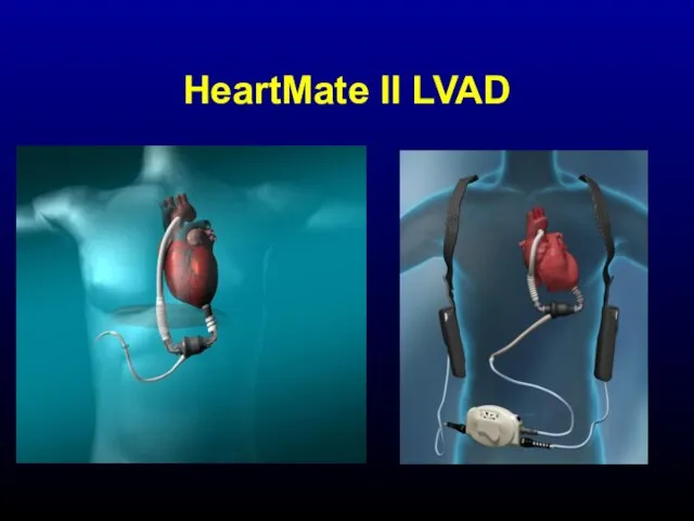 HeartMate II LVAD