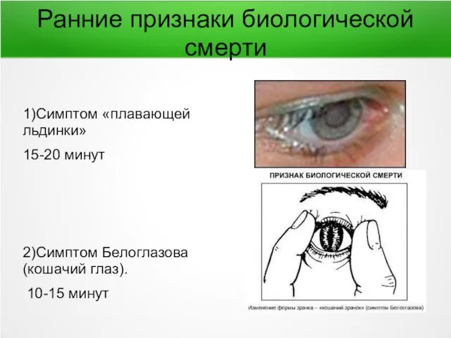 Ранние признаки биологической смерти 1)Симптом «плавающей льдинки» 15-20 минут 2)Симптом Белоглазова (кошачий глаз). 10-15 минут