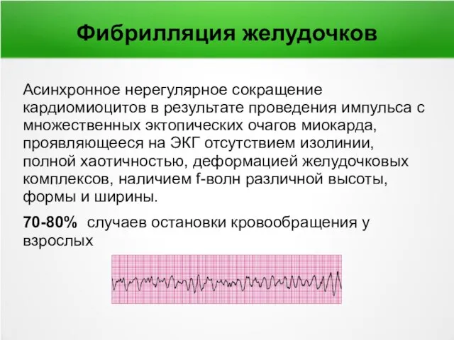 Фибрилляция желудочков Асинхронное нерегулярное сокращение кардиомиоцитов в результате проведения импульса с