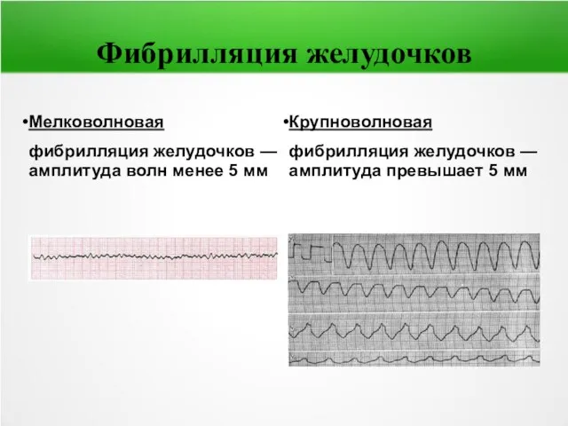 Фибрилляция желудочков Мелковолновая фибрилляция желудочков — амплитуда волн менее 5 мм