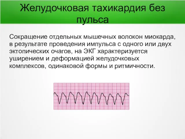 Желудочковая тахикардия без пульса Сокращение отдельных мышечных волокон миокарда, в результате