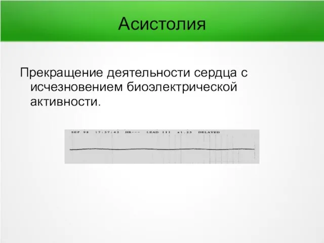 Асистолия Прекращение деятельности сердца с исчезновением биоэлектрической активности.