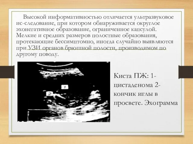 Высокой информативностью отличается ультразвуковое ис-следование, при котором обнаруживается округлое эхонегативное образование,