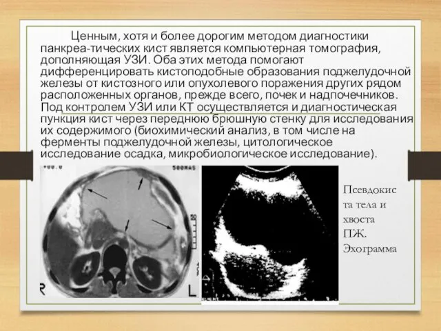 Ценным, хотя и более дорогим методом диагностики панкреа-тических кист является компьютерная