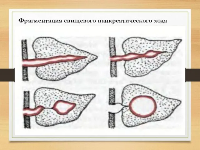 Фрагментация свищевого панкреатического хода