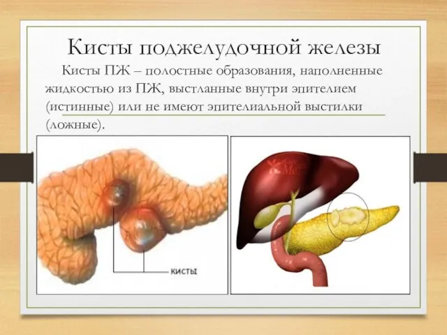 Кисты поджелудочной железы Кисты ПЖ – полостные образования, наполненные жидкостью из