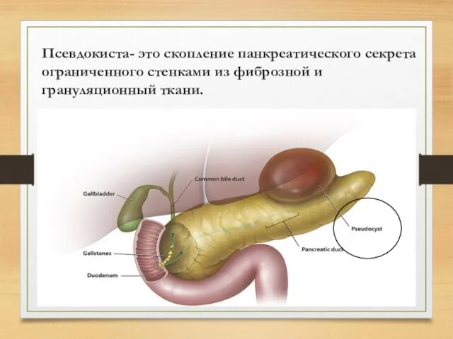 Псевдокиста- это скопление панкреатического секрета ограниченного стенками из фиброзной и грануляционный ткани.