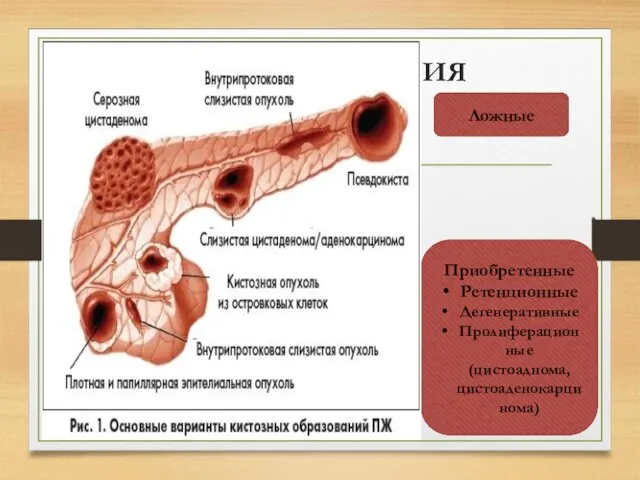 КЛАССИФИКАЦИЯ Кисты поджелудочной железы Истинные Ложные Врожденные Приобретенные Ретенционные Дегенеративные Пролиферационные (цистоаднома,цистоаденокарцинома)