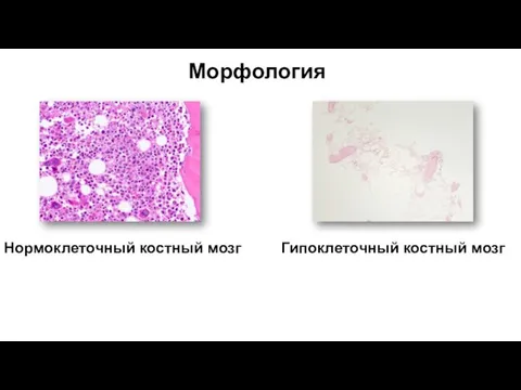 Нормоклеточный костный мозг Гипоклеточный костный мозг Морфология