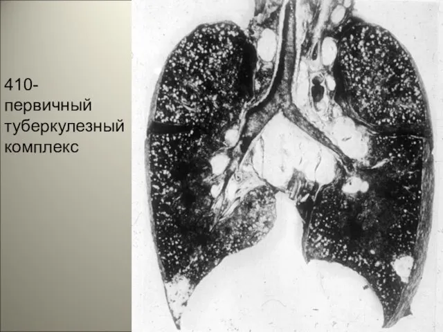 410- первичный туберкулезный комплекс