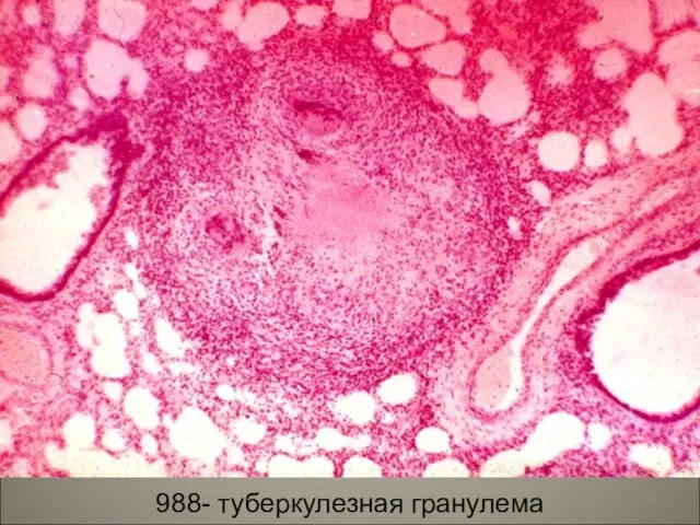 988- туберкулезная гранулема