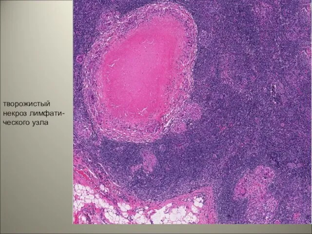творожистый некроз лимфати-ческого узла