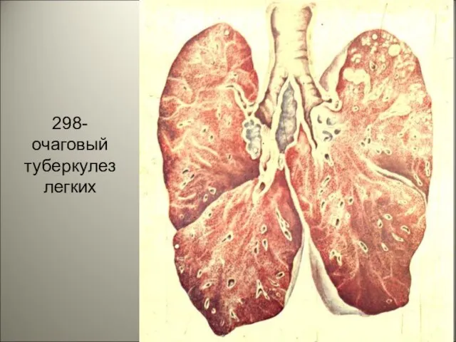 298- очаговый туберкулез легких