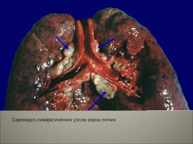 Саркоидоз лимфатических узлов корня легких