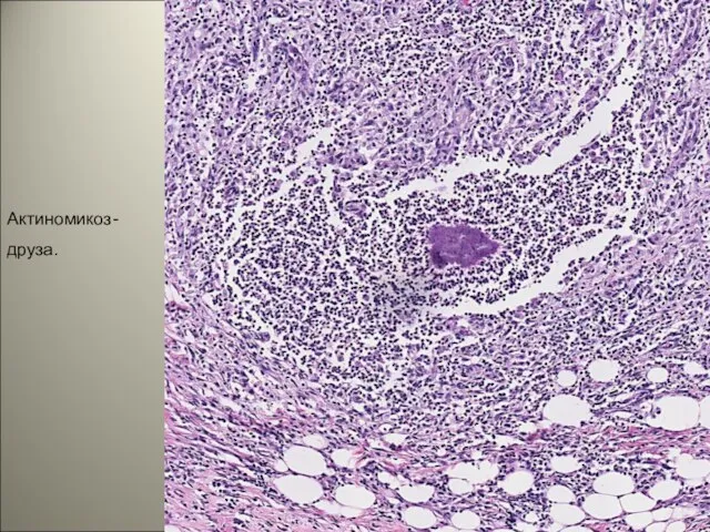 Актиномикоз- друза.