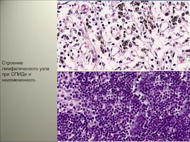 Строение лимфатического узла при СПИДе и неизмененного.
