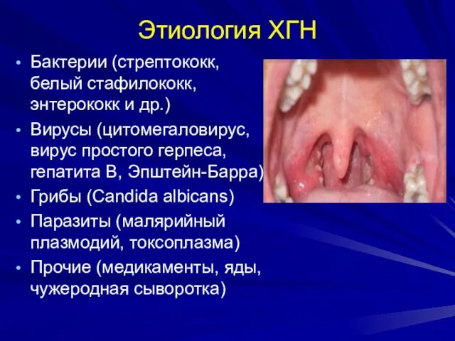 Этиология ХГН Бактерии (стрептококк, белый стафилококк, энтерококк и др.) Вирусы (цитомегаловирус,