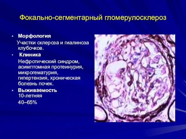 Фокально-сегментарный гломерулосклероз Морфология Участки склероза и гиалиноза клубочков. Клиника Нефротический синдром,