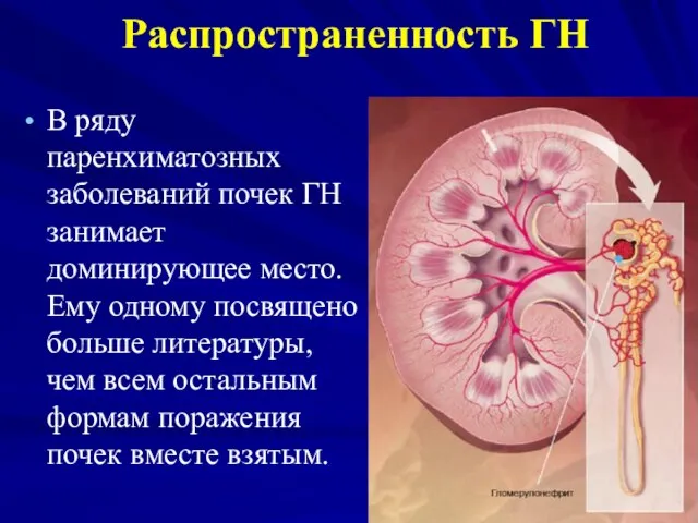 Распространенность ГН В ряду паренхиматозных заболеваний почек ГН занимает доминирующее место.