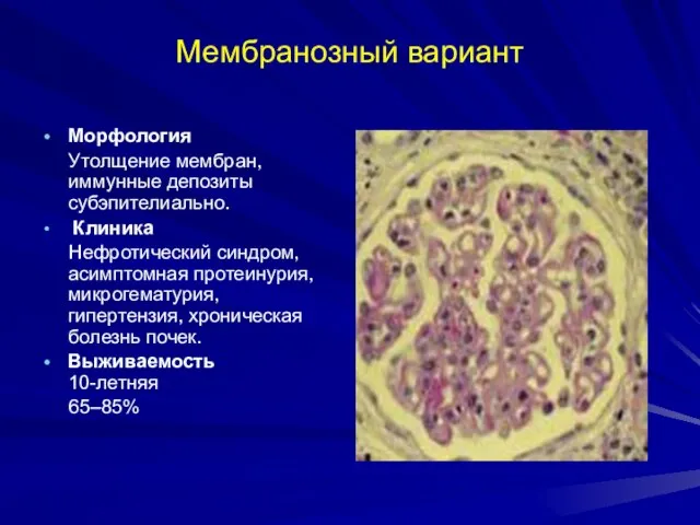 Мембранозный вариант Морфология Утолщение мембран, иммунные депозиты субэпителиально. Клиника Нефротический синдром,