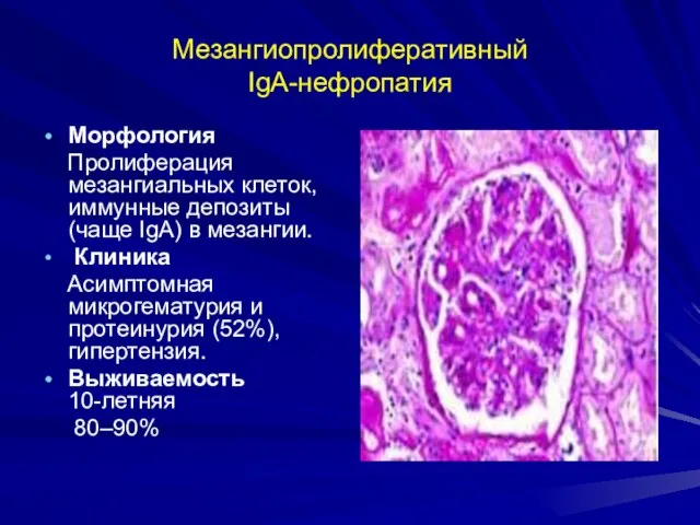 Мезангиопролиферативный IgA-нефропатия Морфология Пролиферация мезангиальных клеток, иммунные депозиты (чаще IgA) в