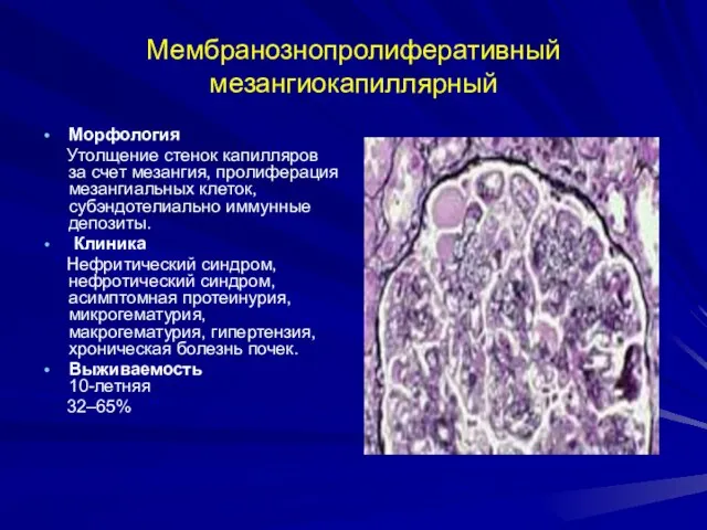 Мембранознопролиферативный мезангиокапиллярный Морфология Утолщение стенок капилляров за счет мезангия, пролиферация мезангиальных