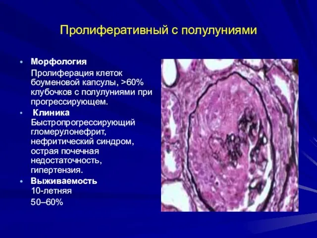 Пролиферативный с полулуниями Морфология Пролиферация клеток боуменовой капсулы, >60% клубочков с