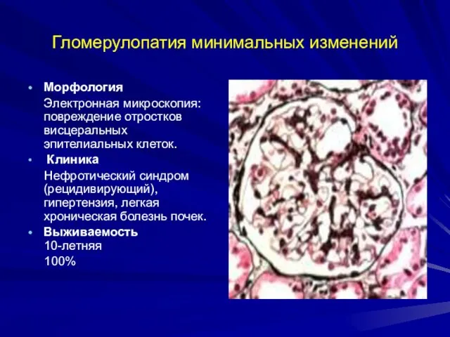 Гломерулопатия минимальных изменений Морфология Электронная микроскопия: повреждение отростков висцеральных эпителиальных клеток.