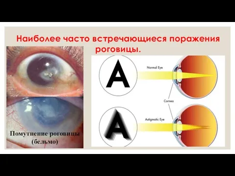 Наиболее часто встречающиеся поражения роговицы. Помутнение роговицы (бельмо)