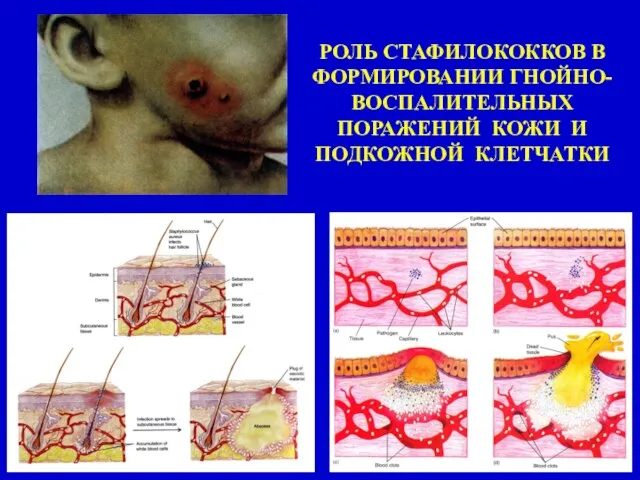 РОЛЬ СТАФИЛОКОККОВ В ФОРМИРОВАНИИ ГНОЙНО-ВОСПАЛИТЕЛЬНЫХ ПОРАЖЕНИЙ КОЖИ И ПОДКОЖНОЙ КЛЕТЧАТКИ