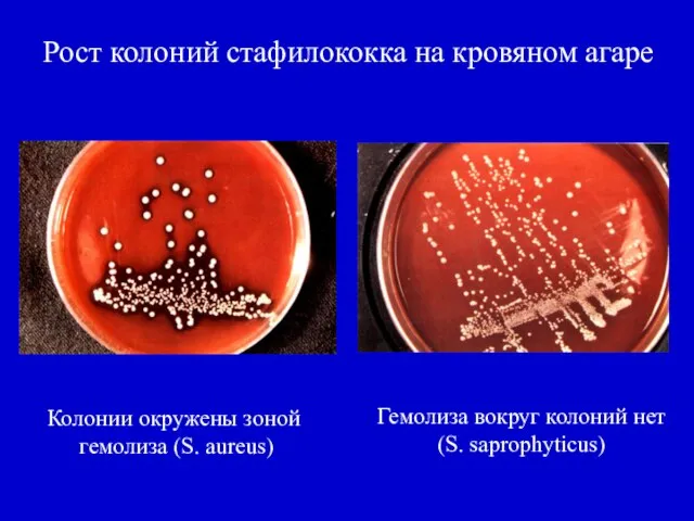 Рост колоний стафилококка на кровяном агаре Колонии окружены зоной гемолиза (S.