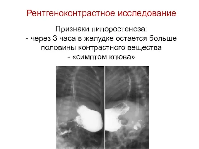 Рентгеноконтрастное исследование Признаки пилоростеноза: - через 3 часа в желудке остается